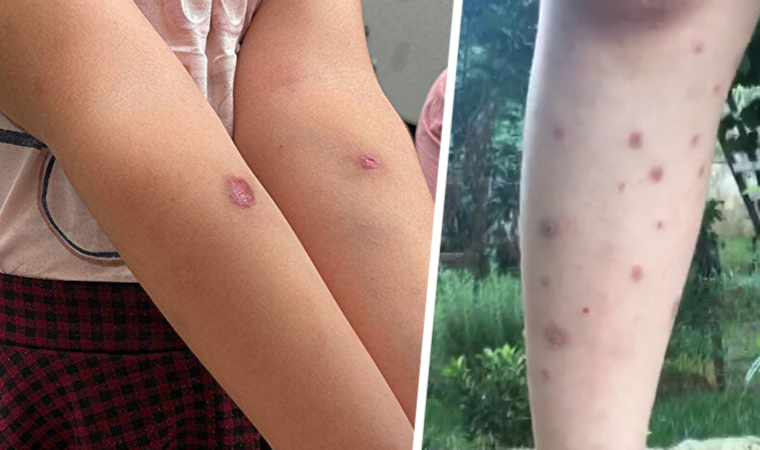 Asya kaplan sivrisineği ısırığında 3 ölümcül hastalık riski var