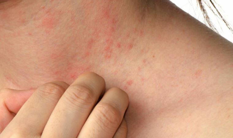 Bu belirtiye dikkat! Kaşıntı, önemli hastalıkların habercisi olabilir