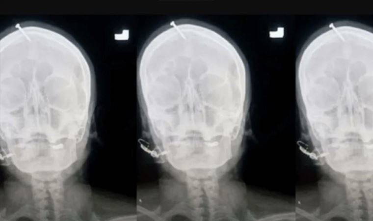 Hamile kadın erkek çocuk doğurmak için kafasına çivi çaktırdı