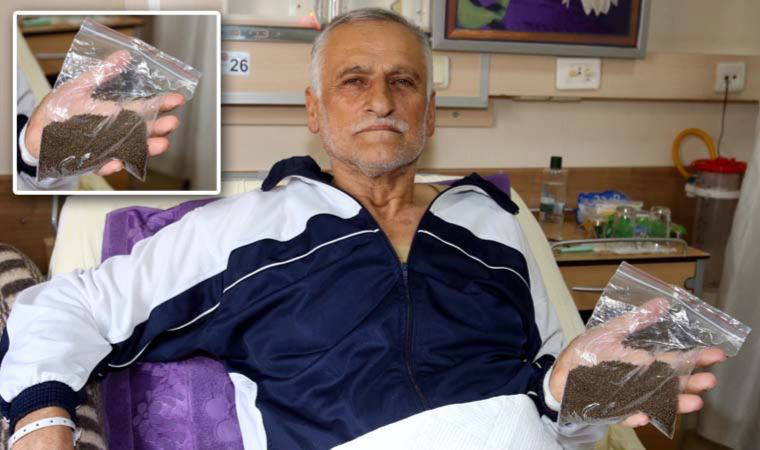 Safra kesesinden 14 bin 387 adet taş çıkartıldı: Guinness'e başvuracak