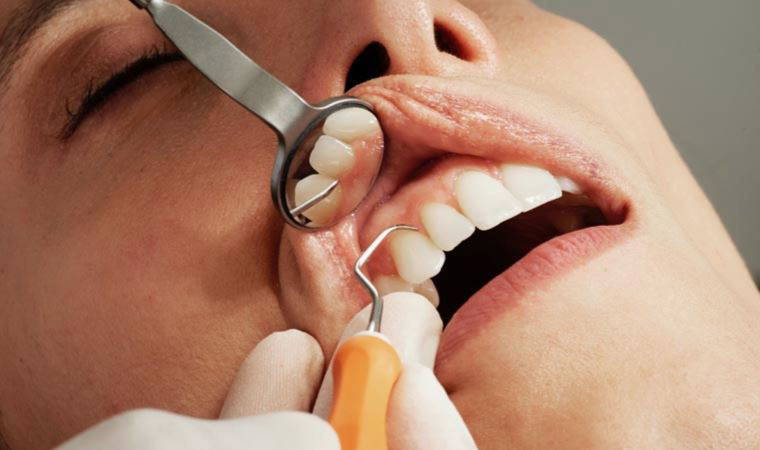 Uzmanından diş çürüklerine karşı 'gargara' önerisi