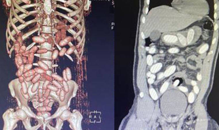 7 yolcunun midesinden 11 kilo kokain çıktı