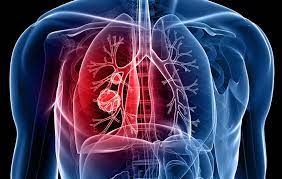 24 Mart Dünya Tüberküloz Günü: Pandemi sonrası verem artabilir! İşte tüberkülozun en önemli 6 belirtisi