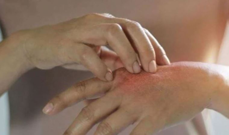 Uzman Dermatolog Metin Oğuz, artan uyuz vakaları hakkında konuştu: İlaçlar çok etkili değil