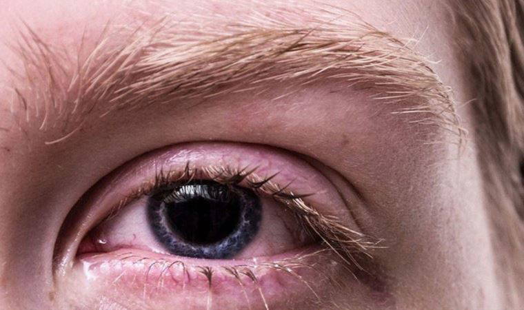 Gözdeki kızarıklığa dikkat!