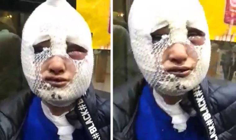 Eski kız arkadaşının yüzüne kızgın yağ döken zanlı 2 buçuk ay sonra tahliye oldu