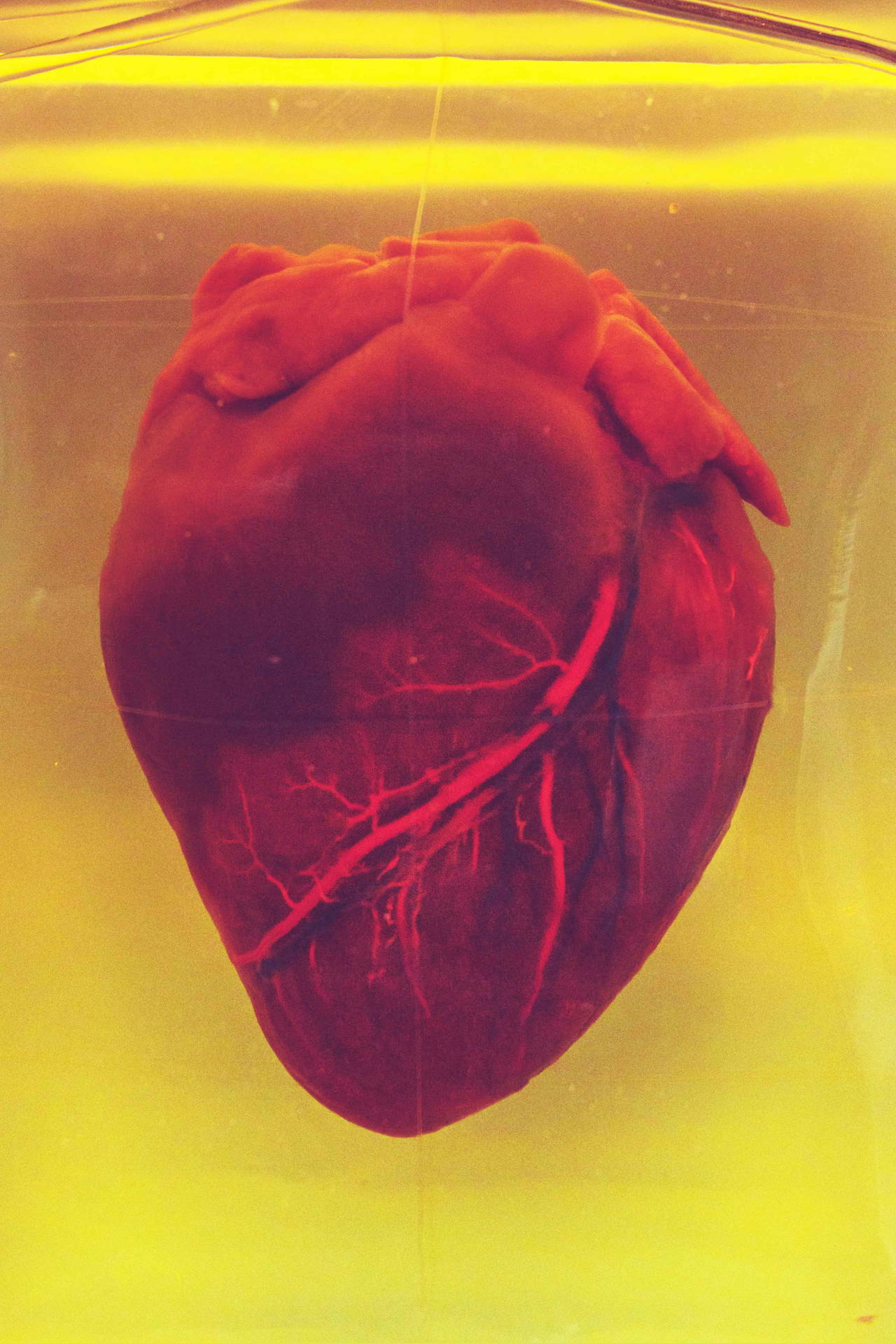 Buerger hastalığı nedir, belirtileri neler, nasıl tedavi edilir?