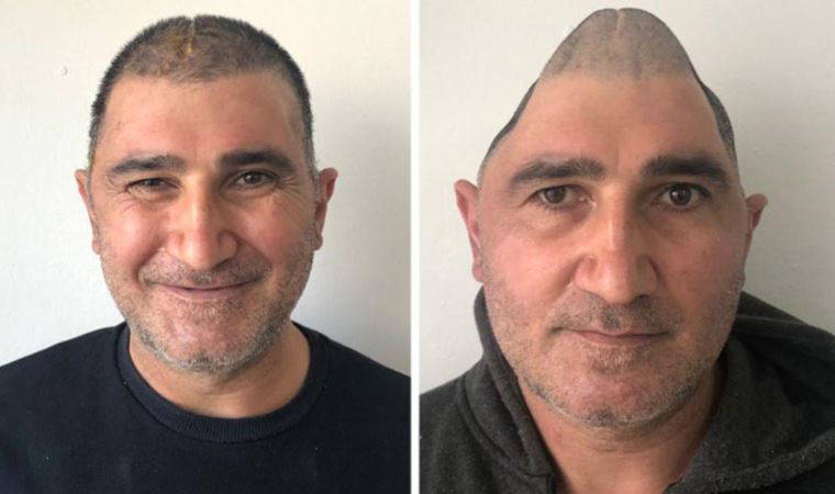 Kafatasının yüzde 83'ü parçalanmıştı