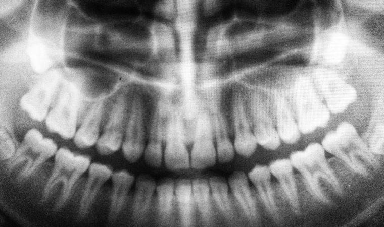 Bruksizm (Diş Sıkması) nedir, sebepleri neler, nasıl tedavi edilir?
