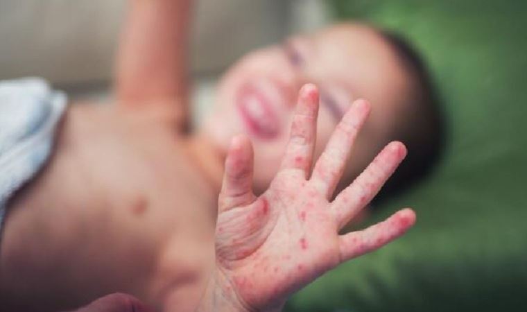 El, Ayak, Ağız Hastalığı neden olur? El, Ayak, Ağız Hastalığı tedavisi nasıl olur?