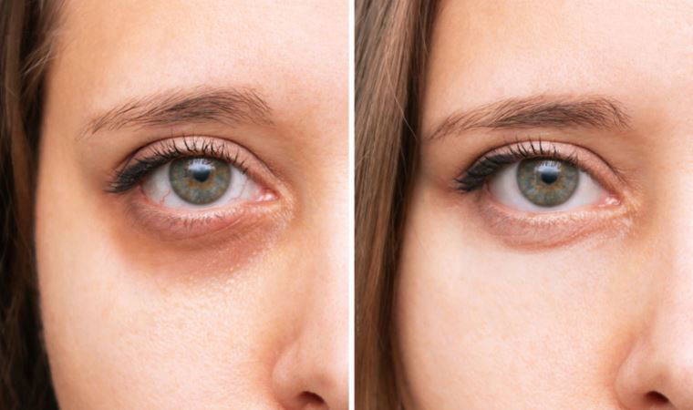 Uzmanı uyardı: 'Göz altındaki mor halkalar basit bir cilt problemi olmayabilir'