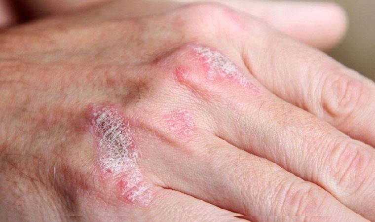 Sedef hastalığı nedir, belirtileri nelerdir? Sedef hastalığı nasıl tedavi edilir?