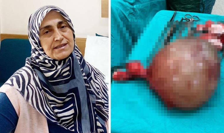 Karnından 3 kiloluk kitle çıkartıldı: '57 yaşındayım, dünyaya yeni geldim'
