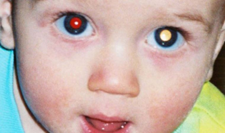 Dikkat! Çocuk fotoğraflarında kırmızı çıkan göz bebeği rengi sağlık sorunu habercisi
