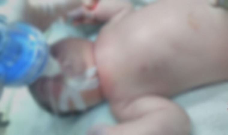 Doğumda 'köprücük kemiği' kırıldığı iddia edilen bebek entübe edildi (23 Mayıs 2022) (Video Haber)