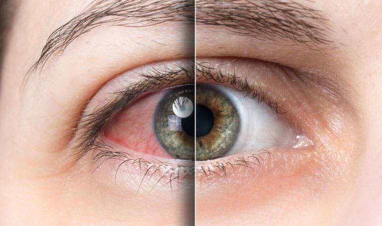 Uzmanından gözlerdeki kaşınmaya ilişkin açıklama