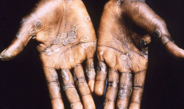 İrlanda'da ilk maymun çiçeği vakası görüldü