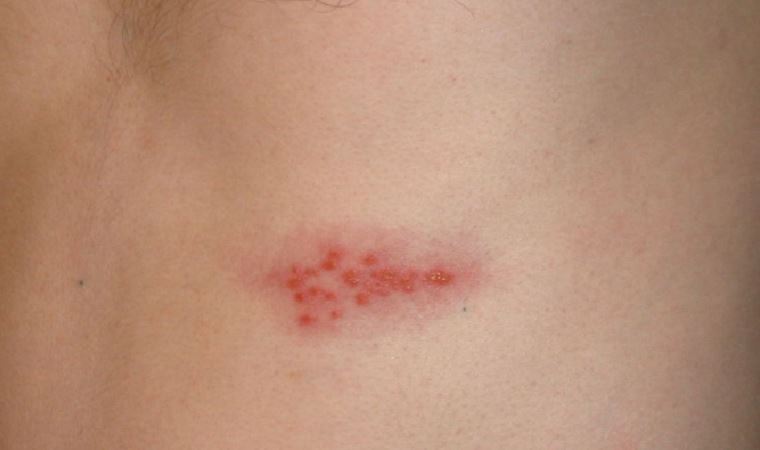 Zona nedir? Zona belirtileri nelerdir? Zona neden olur?