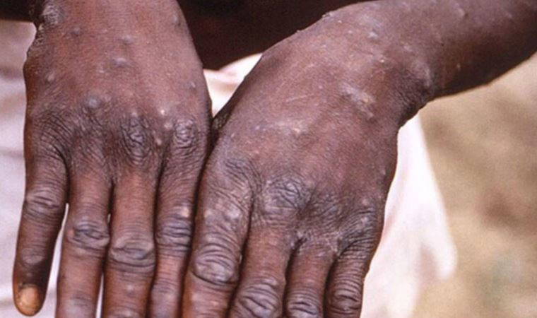 Brezilya'da ilk maymun çiçeği vakası görüldü