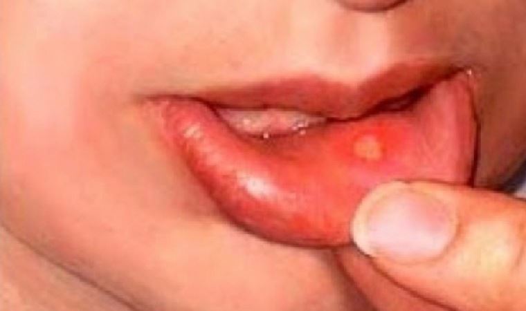 Behçet hastalığı nedir, belirtileri nelerdir? Behçet hastalığı neden olur, tedavisi nedir?