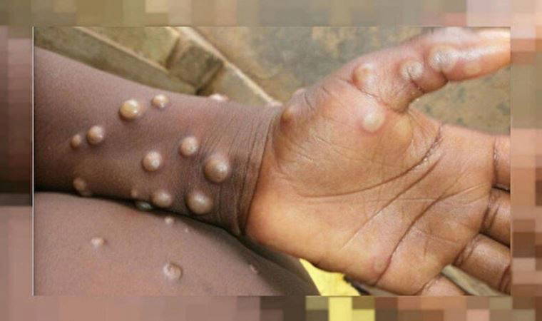 Maymun çiçeği virüsü belirtileri nelerdir? Maymun çiçeği virüsü Türkiye'de görüldü mü? İstanbul'da maymun çiçeği vakası var mı? Fahrettin Koca açıkladı...