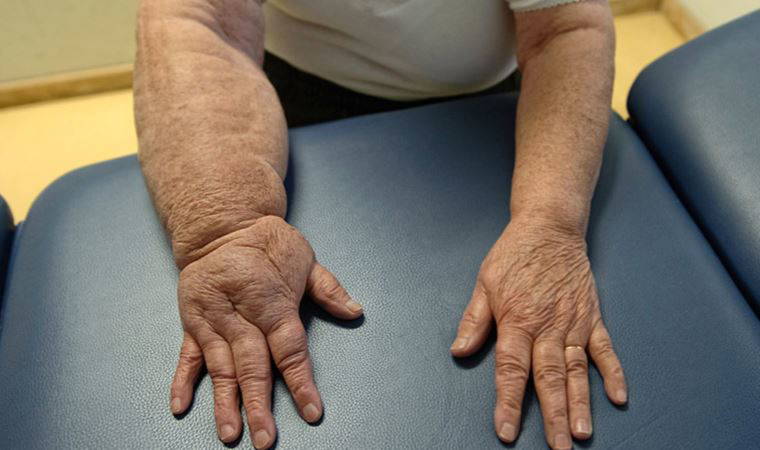 Lenfödem hastaları dikkat!