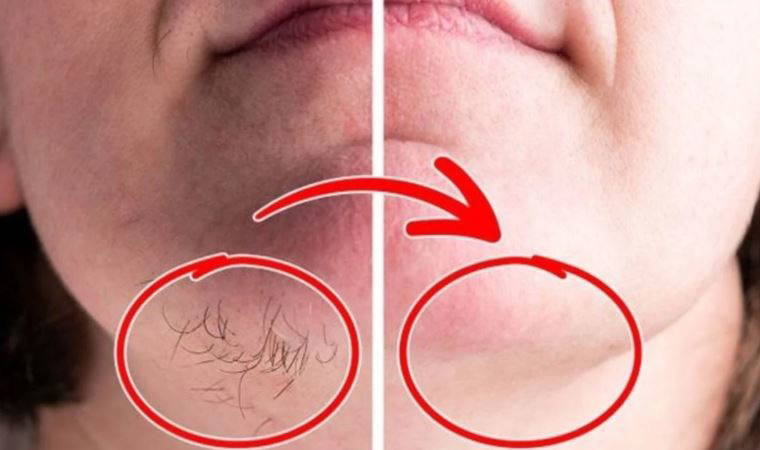 Yüzünüzdeki istenmeyen tüylerden kurtaran doğal yöntem! Çok etkili