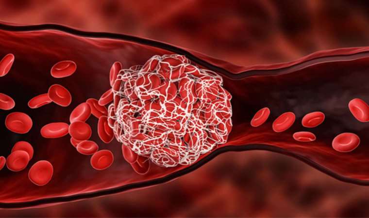 Damarlarında tekrarlayan pıhtı oluşuyordu, sebebi herkesi şaşırttı