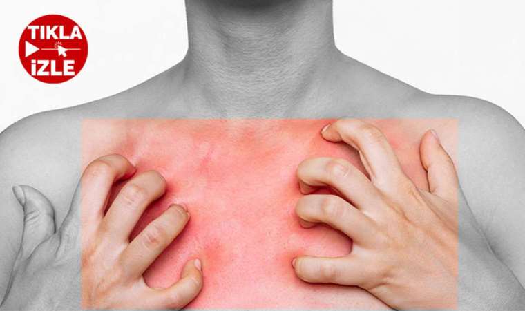 Uyuz vakaları yüze 40 oranında arttı: Uyuzdan nasıl korunulur?