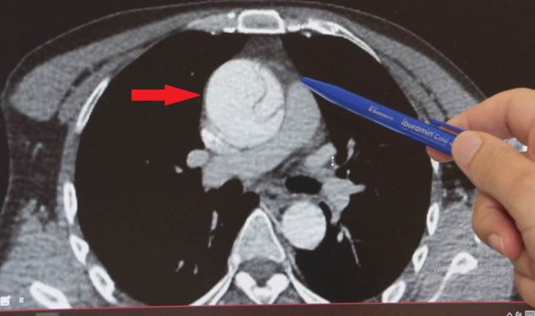 Acildeki doktorun dikkati sayesinde kurtuldu... Mide ağrısı sandı, aort damarında 'yırtık' çıktı