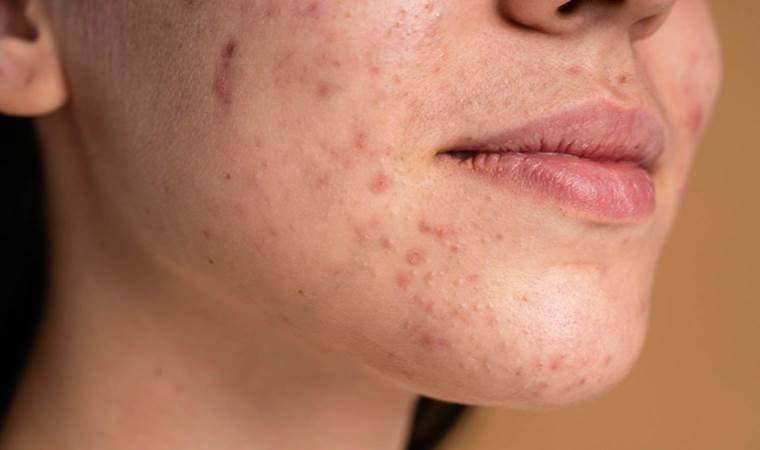 Dermatologlar anlattı: Sivilcelerinizden nasıl kurtulursunuz?