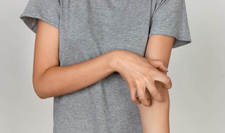 Uzmanı uyardı: 'Uyuz tedavisinde ilaçlar yetersiz kalıyor'