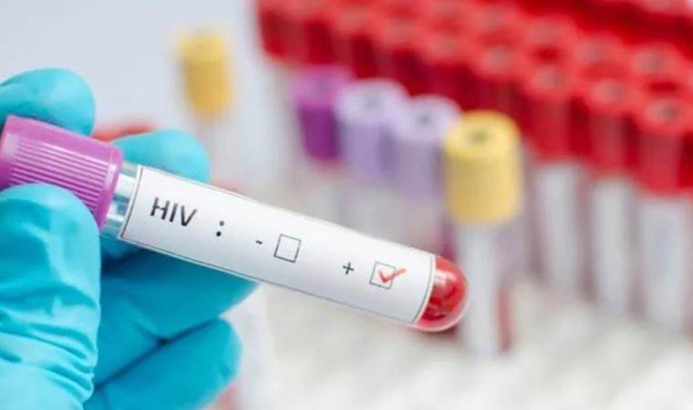 HIV erken tanı ve tedaviyle "yönetilebilir" bir hastalık