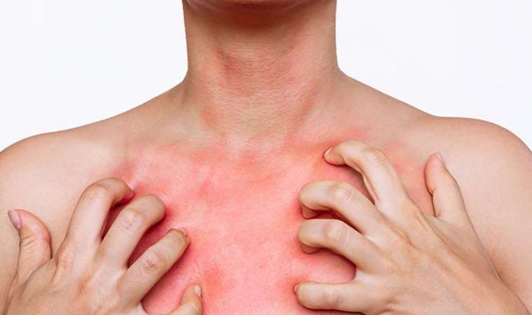 Uzmanlar uyardı: Gece kaşıntıları uyuz belirtisi olabilir!