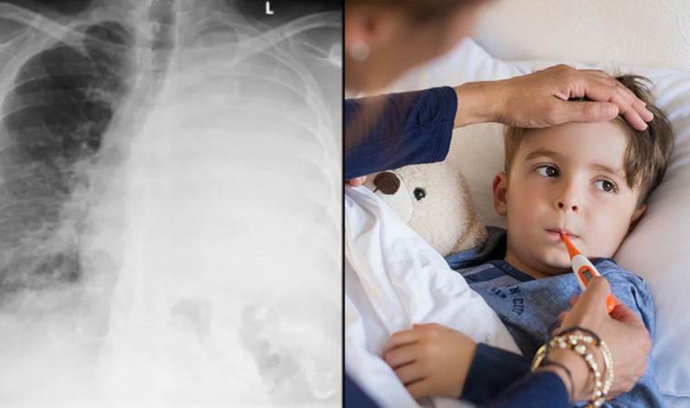 'Beyaz Akciğer Sendromu' vakalarında artış