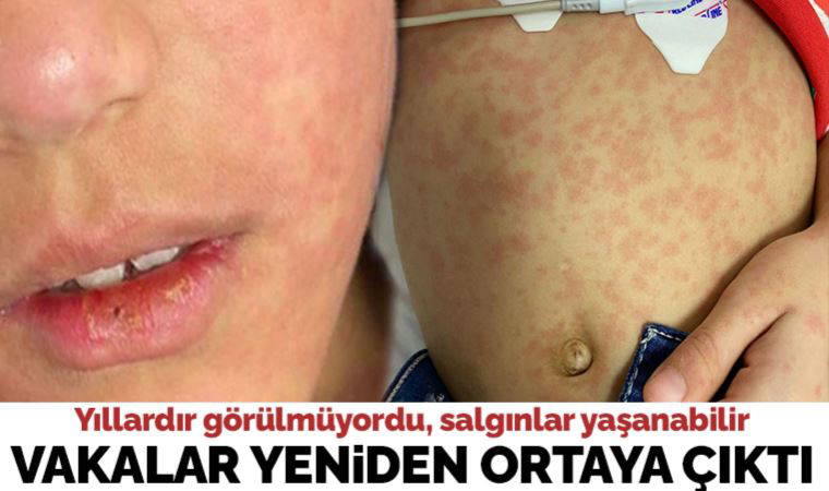 Yıllardır görünmüyordu... Kızamık vakaları yeniden ortaya çıktı