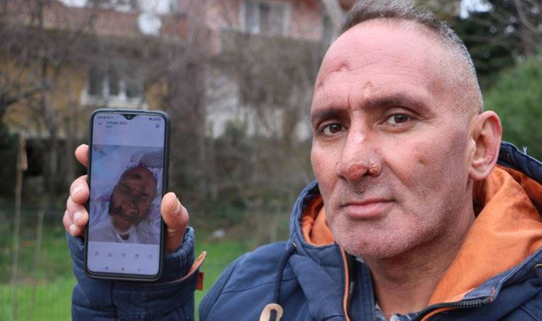 Vücudunu ısıran sinek yüzünü tanınmayacak hale getirdi: 'Çalışma hayatım bitti'
