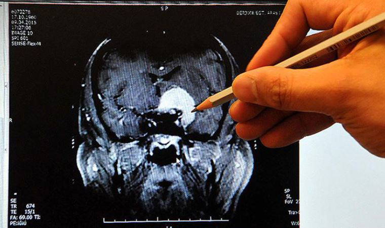 Prof. Dr. Nuri Tutar: 'Ayakta başlayan pıhtı ölüme kadar götürebilir'