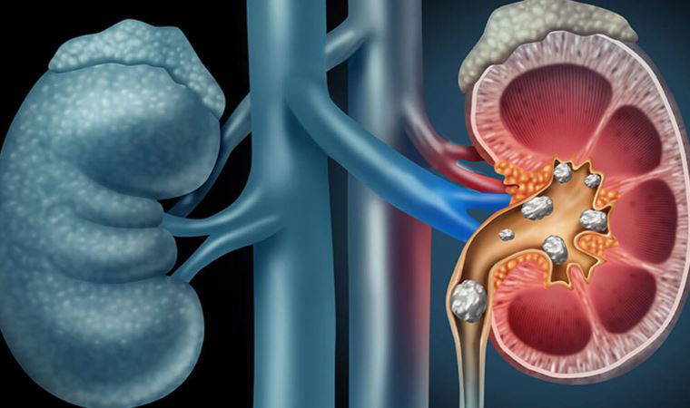 Üriner sistem taş hastalığının altında yatan nedenlere dikkat
