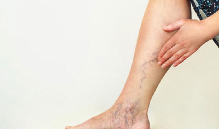 Radyoloji uzmanı uyardı: Varis, en çok o meslek gruplarını etkiliyor