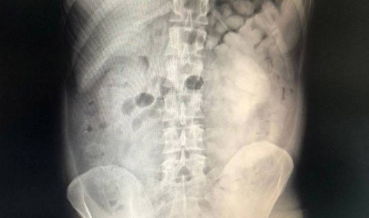 Diyarbakır’da şüpheli yolcunun midesinden 800 gram eroin çıktı