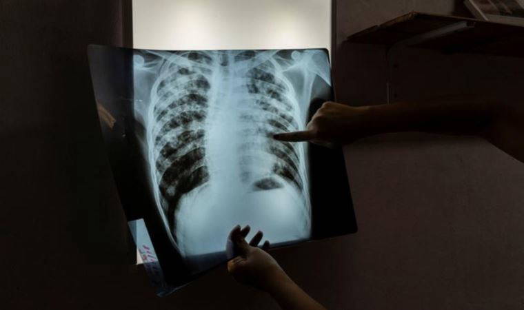 Avrupa'da tüberküloz ölümleri yeniden artıyor