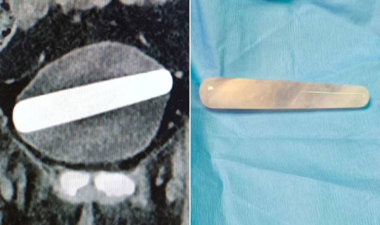 Doktorlar: 'Bu bir rekor...'