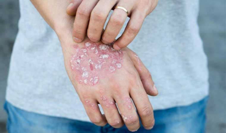 Prof. Dr. Müge Güler: 'Artık günümüzde şanslı hasta gruplarının başında sedef hastaları geliyor'