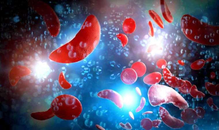 Orak hücre anemisi: Afrika'da çok zor mücadele edilen genetik hastalık