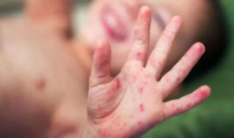 Prof. Dr. Şener: 'Kızamığa salgın demek için elimizde net bir veri yok'