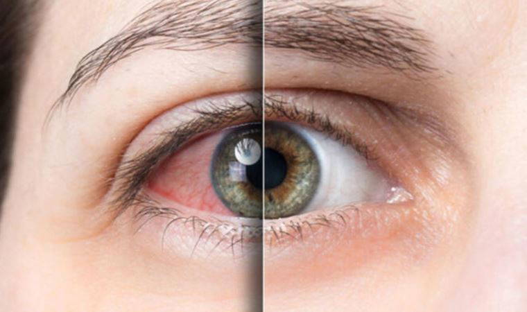 Prof. Dr. Demirci: Gözdeki kaşıntının altından demodeks çıkabilir