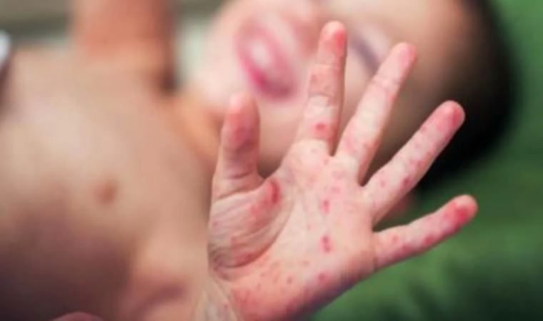 Türkiye kızamıkta Avrupa 2.si oldu!