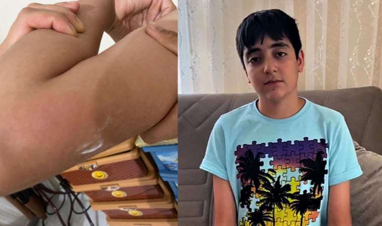 13 yaşındaki Yasin, balkona atılan torpille yaralandı