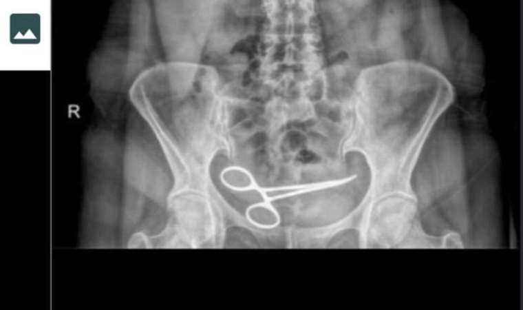 Karnında makas unuttular: 8 ay sonra fark edildi!